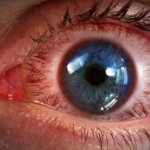 Chloropyramine-lf solution instructions for use