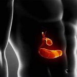 холецистит