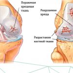 Хрящ здоровый и пораженный артрозом