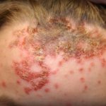 impetigo