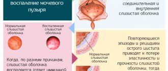Indomethacin suppositories. Instructions for use in gynecology, during pregnancy, after surgery. Price, analogues