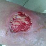 Инфицированная рана