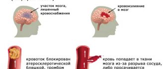 Stroke