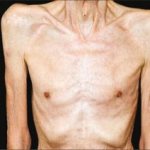 истощенный больной при протозойной инфекции