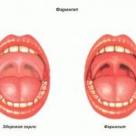 Изображение 1: Фарингит - клиника Семейный доктор