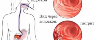 Изображение 1: Гастрит - клиника Семейный доктор