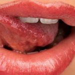 как лечить глоссит языка