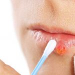 How to apply Acyclovir ointment for herpes