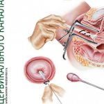 Как врачи берут мазок из цервикального канала