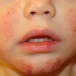 как выглядит экссудативный диатез у ребенка