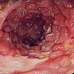 Как выглядит острый колит кишечника