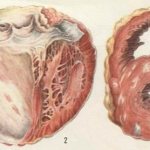 Кардиофиброз