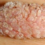 Классификация ИППП: вирус папилломы человека