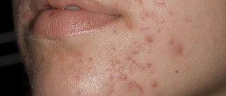 комфодерм состав мази