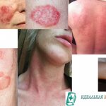 Красные пятна на теле у взрослых и детей