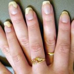 Treatment of fungus on nails