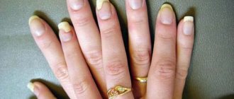 Treatment of fungus on nails