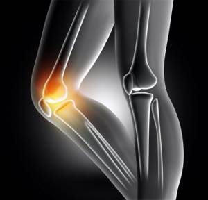 Лечение остеоартроза коленного сустава