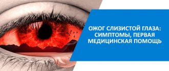 лечение ожога глаз