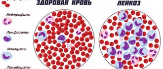 Лимфолейкоз