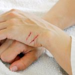 Мазь используют для лечения повреждений кожи