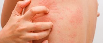 Мази для рассасывания гематом, синяков, шишек после удара, от уколов, после операции