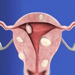 миома матки