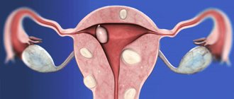 миома матки