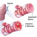 мокрота в бронхах