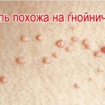 Моллюски на лице у ребенка. Причины и лечение, как убрать народными средствами