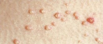 Molluscs on a child's face. Causes and treatment, how to remove with folk remedies