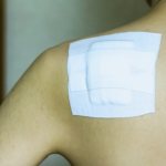 Applying a patch after cyst removal