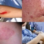 Наружные поражения кожи