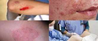 External skin lesions