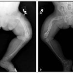 Osteogenesis imperfecta