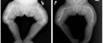 Osteogenesis imperfecta