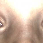 Нистагм глаз