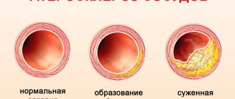 Образование атеросклероза