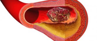 blood clots