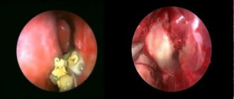 examination of nasal cavities