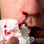 Одно из проявлений лучевой болезни – геморрагический синдром