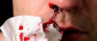 Одно из проявлений лучевой болезни – геморрагический синдром