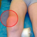 Осложнения