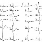 Основной метод диагностики инфаркта – ЭКГ