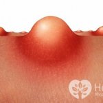 The main cause of an abscess is the penetration of pyogenic microflora through the skin and mucous membranes