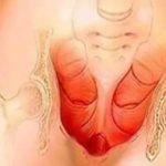 Features of atrophic colpitis