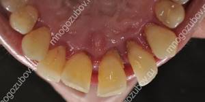 Пародонтит - основная причина подвижности зубов