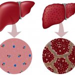 Патологии печени