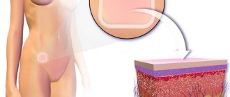 Пластырь как метод контрацепции