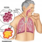 пневмония жидкость в альвеолах